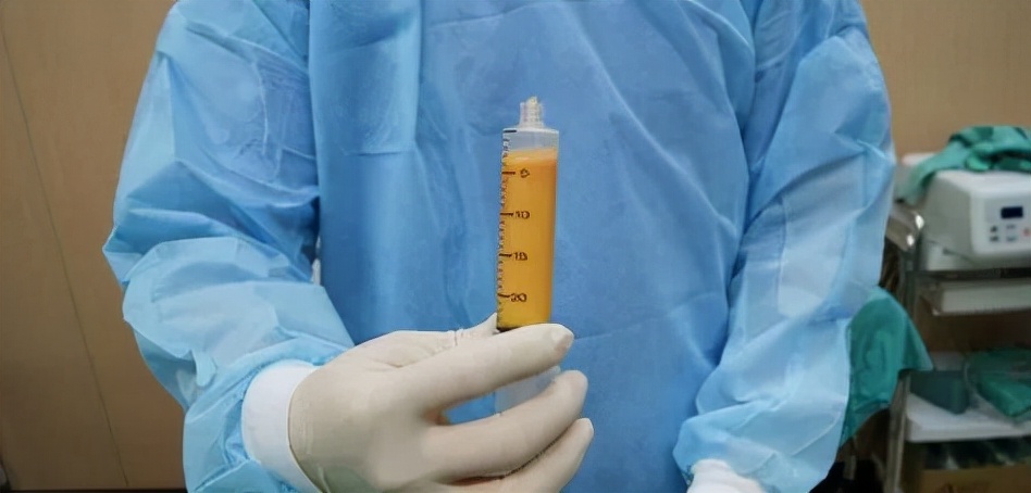 自体脂肪填充过量下巴凸,自体脂肪填充过多怎么处理