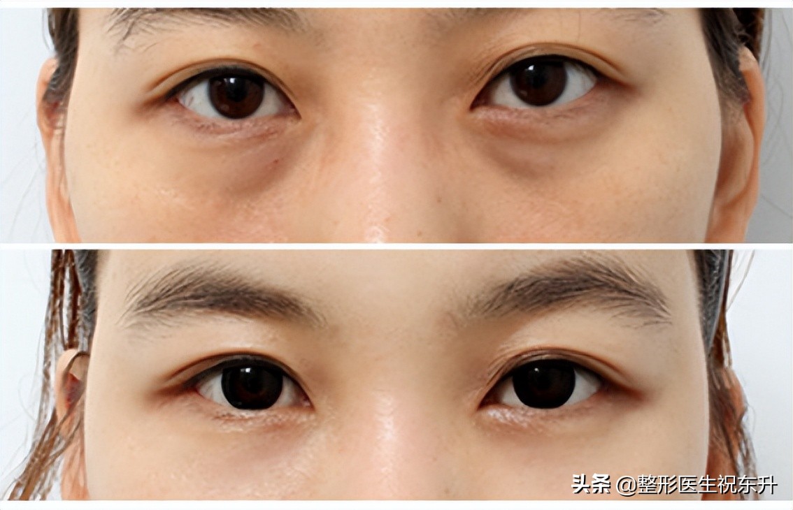 做眼袋手术后的真实经历,去眼袋外切手术26天亲身经历日记