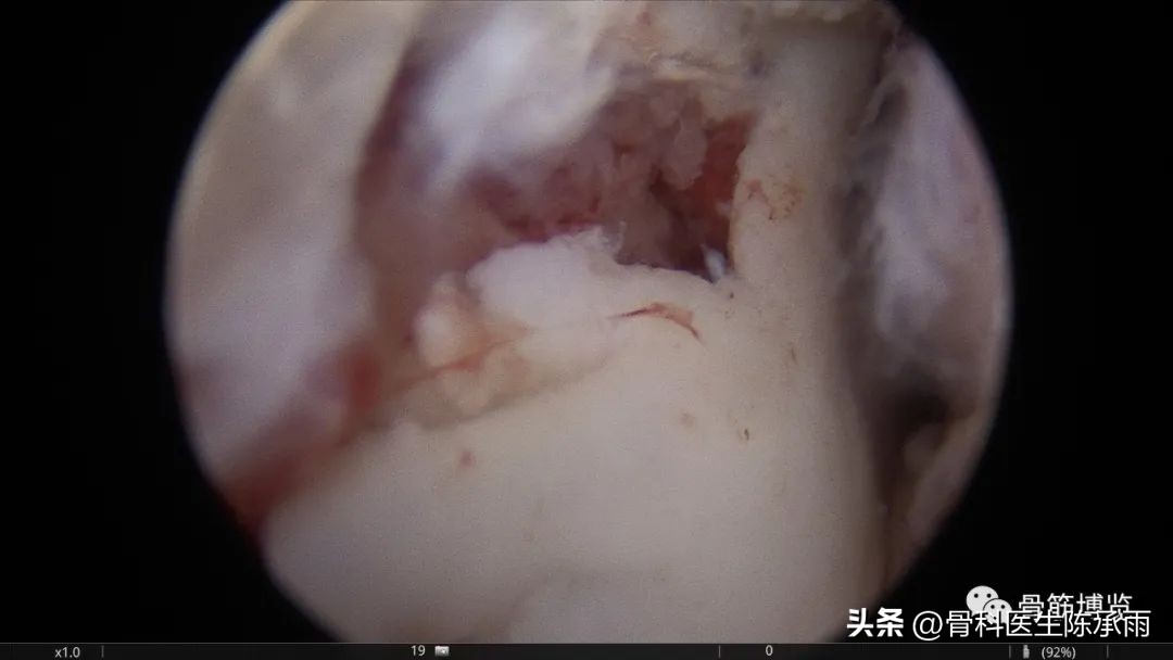 化脓性关节炎的穿刺引流治疗,关节炎镜下治疗