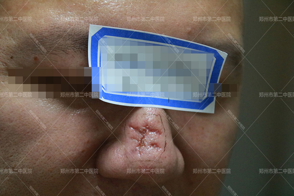 河南哪里治疗疤痕,治疗刀疤的医院