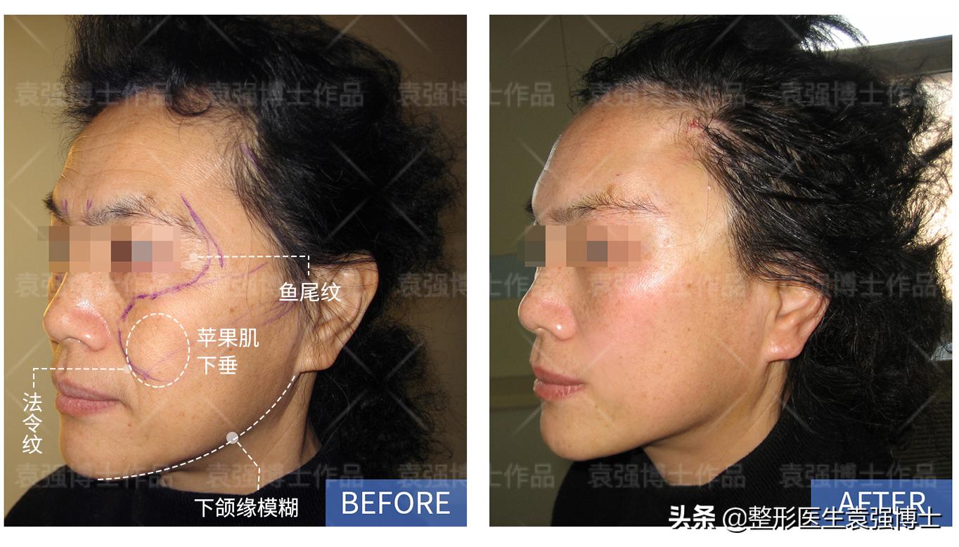 小切口面部提升能维持多久,面部提升的穴位手法完整视频