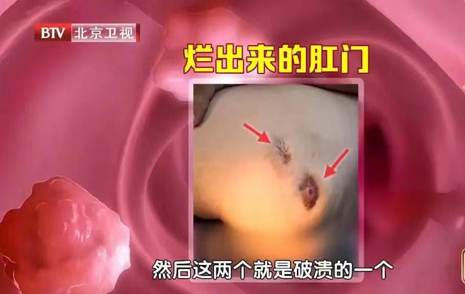 痔疮洗屁股刺痛怎么办,屁股清洗不干净会有瘙痒症状吗