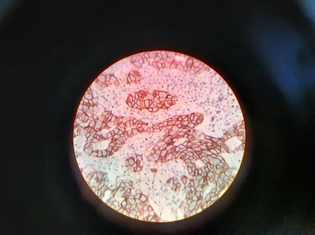 HPV感染和宫颈癌的预防与早期发现