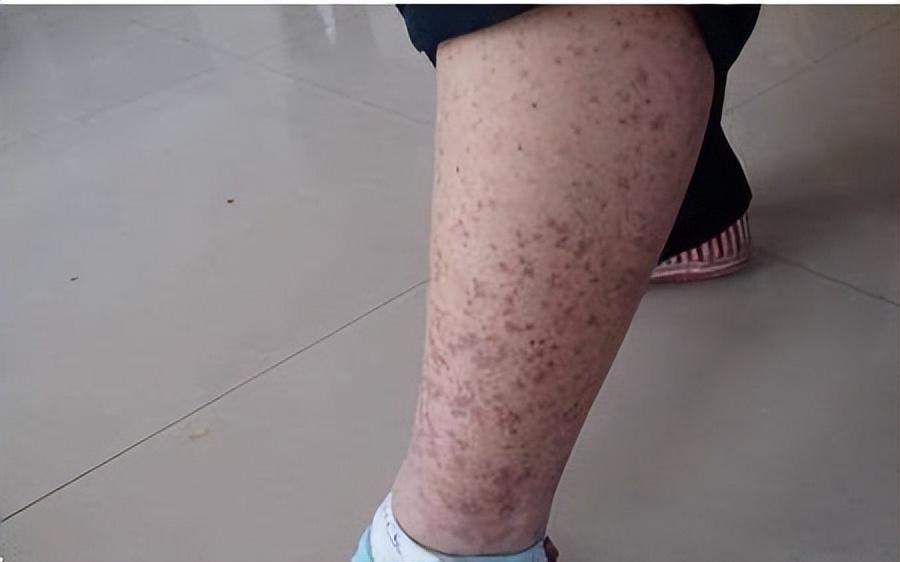 清肾丸治疗紫癜,紫癜针灸治疗