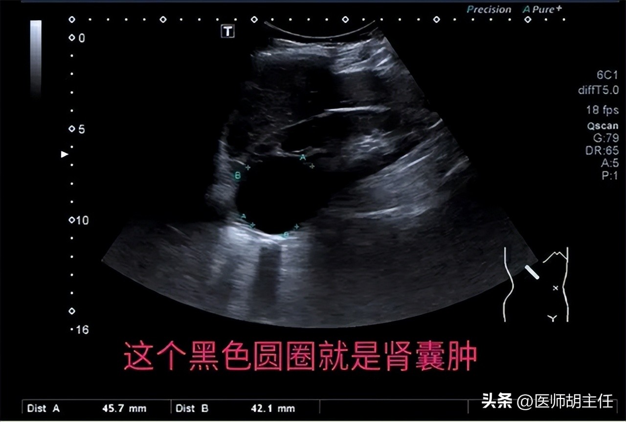 体检肝部囊肿最大2.8怎么办,体检发现肝囊肿肾囊肿