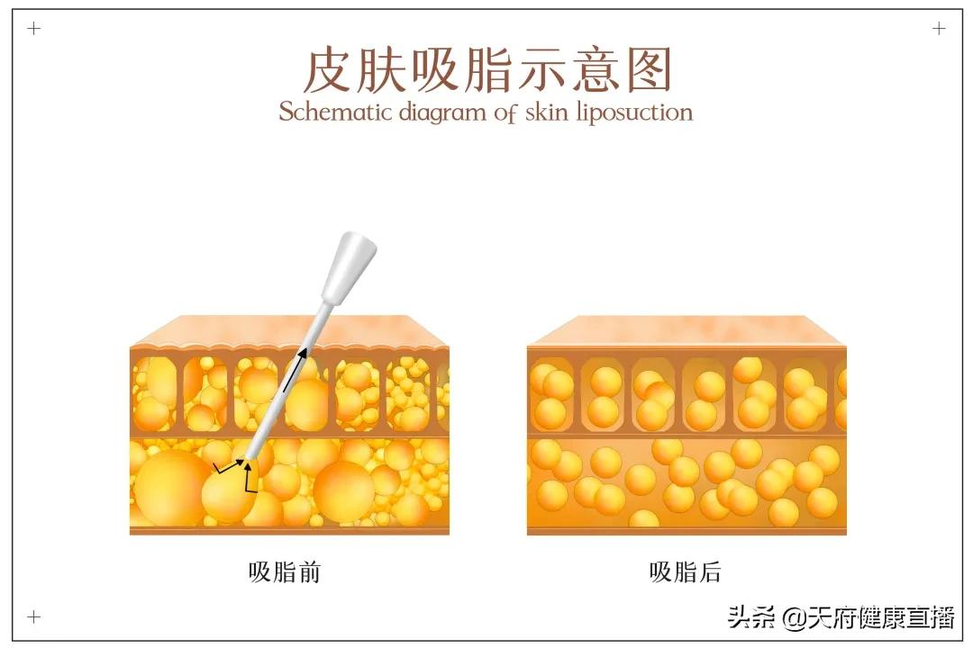 吸脂会皮肤松,吸脂太多可以脂肪填充补回来吗
