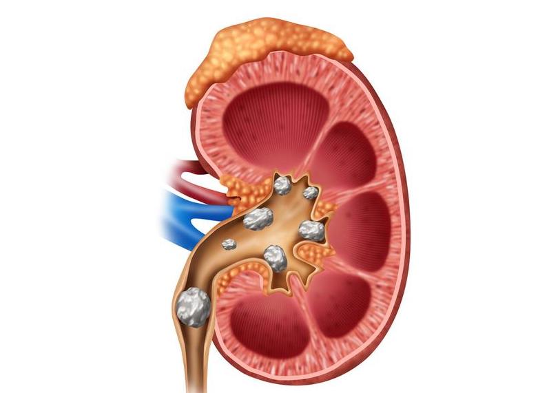 儿童有肾结石,儿童多发性肾结石