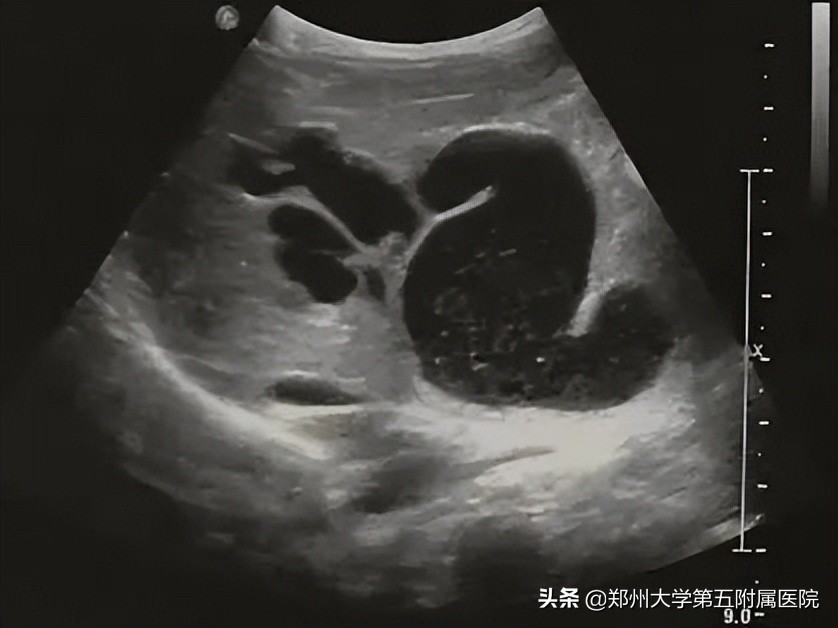 黄疸患者如何用超声诊断与鉴别,小儿黄疸超声筛查