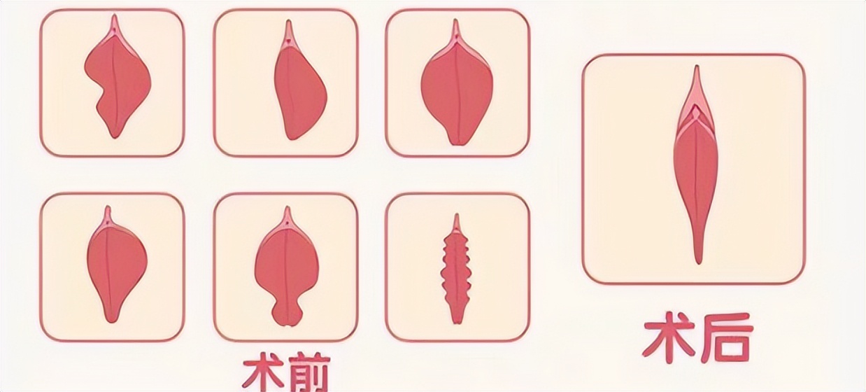 外阴肥大最简单的自愈方法,外阴肥大科普