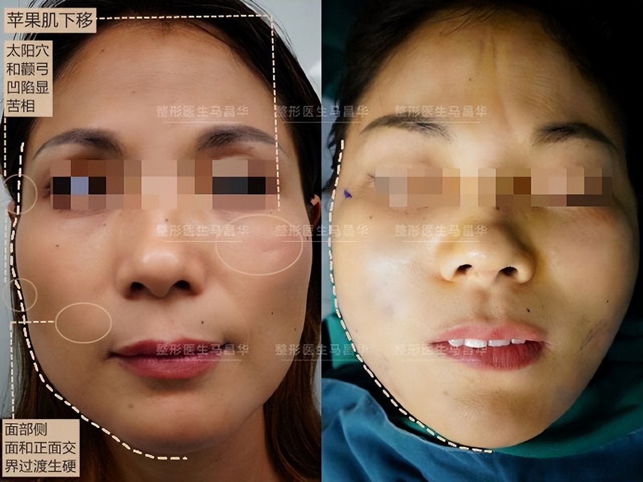 法令纹最好有效的去除方法,有法令纹最好的解决办法真实有效