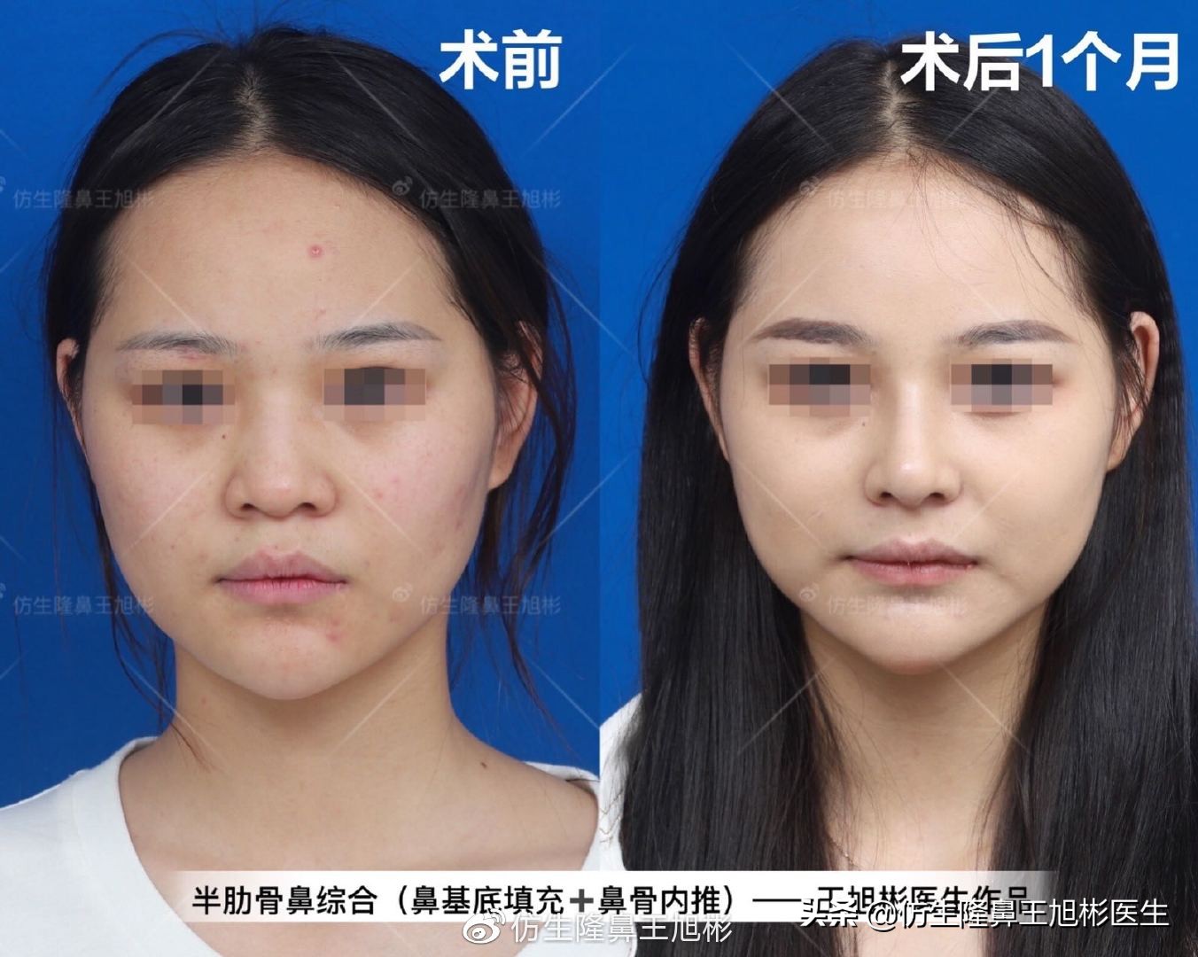 常见鼻部整形美容项目,整形鼻和自然鼻