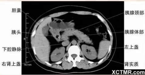 胸腹部盆腔ct主要检查什么,女性盆腔ct断层解剖结构图