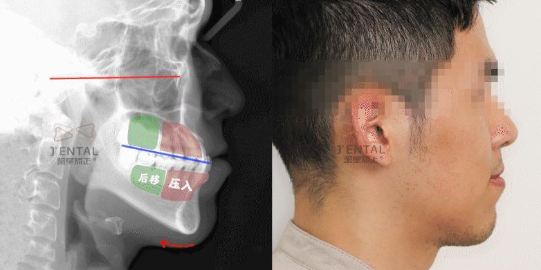 骨性上颌前凸嘴怎么矫正,厚嘴唇与嘴凸有关吗