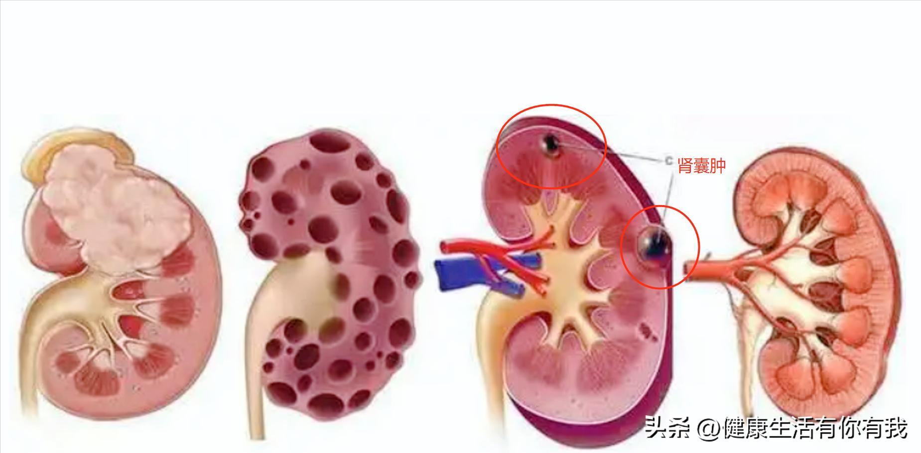 什么是血尿和尿潜血,什么是血尿是怎么回事