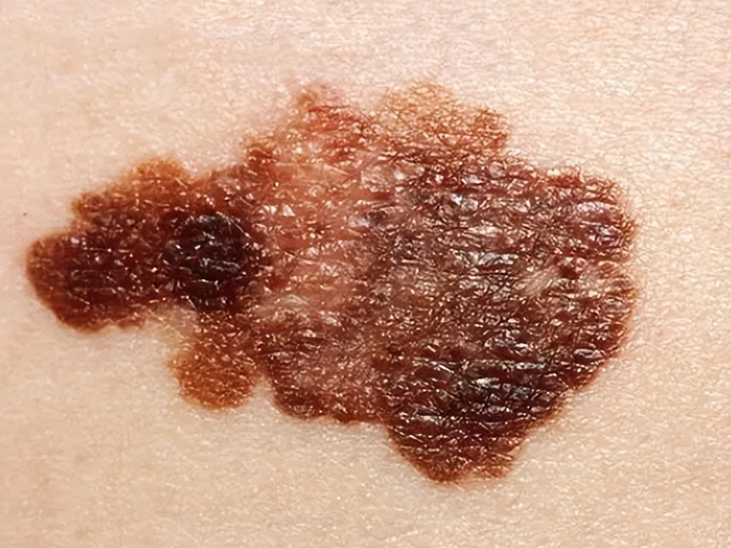 mrna技术预防黑色素瘤,松花粉可以预防黑色素瘤吗