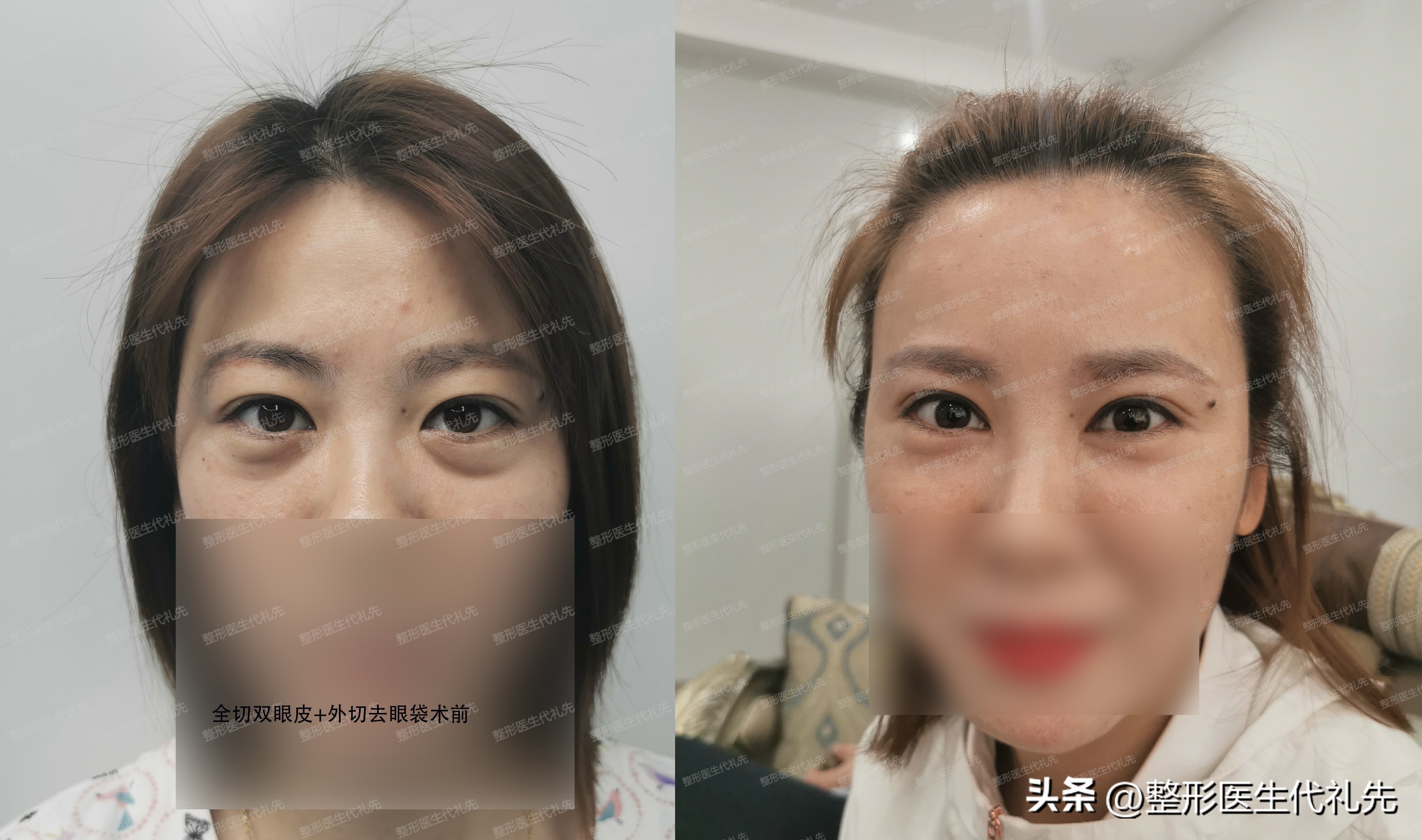 眼袋形成的真正原因,眼袋是怎么形成的去除眼袋的方法