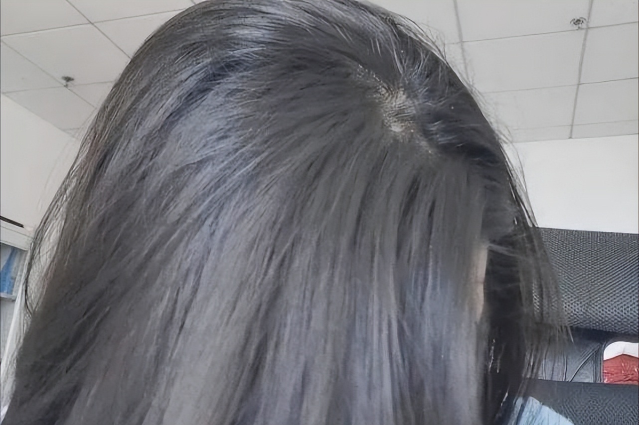 头顶头发稀疏露头皮治疗,头顶稀疏露头皮怎么办