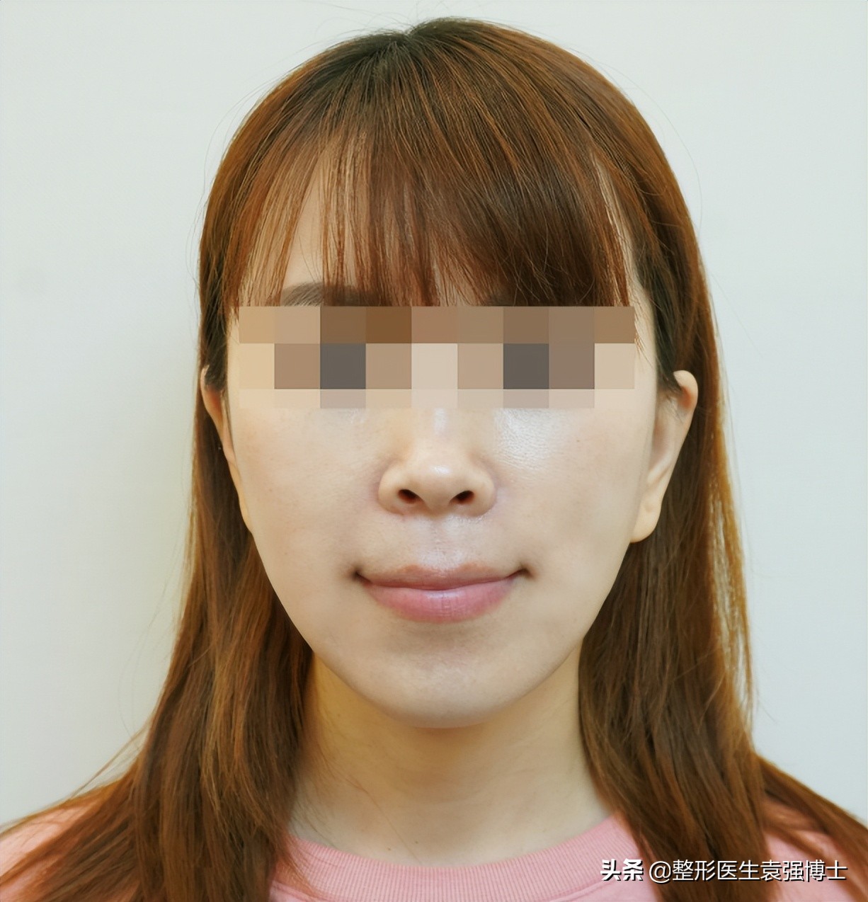 拉皮术后无美颜对比图,40岁拉皮术后恢复视频