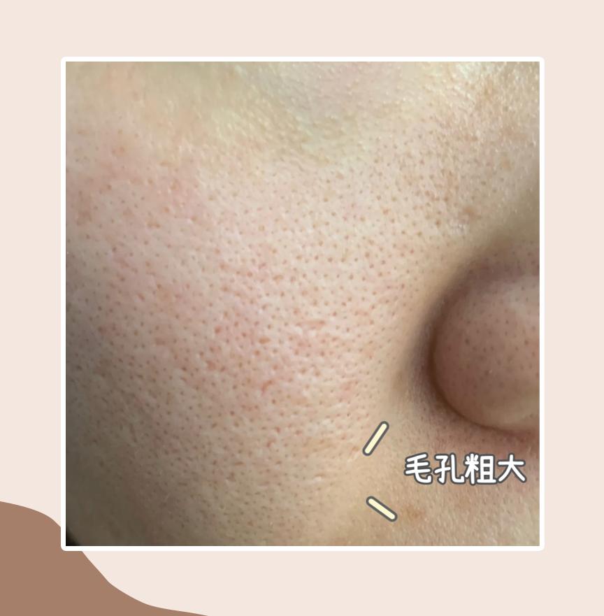缩毛孔最简单方法,缩毛孔的方法亲身经历