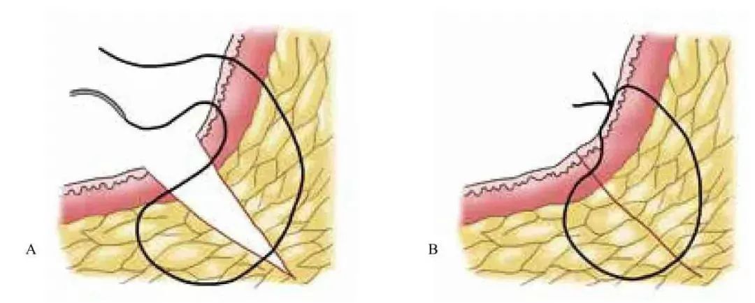外科顶级缝针技术,外科缝合的操作细节你掌握多少