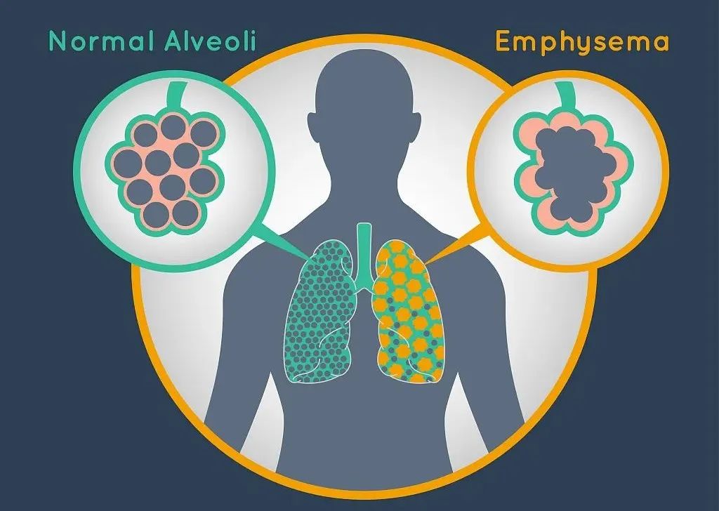 肺气肿早期的症状和治疗,关于肺气肿的症状和治疗