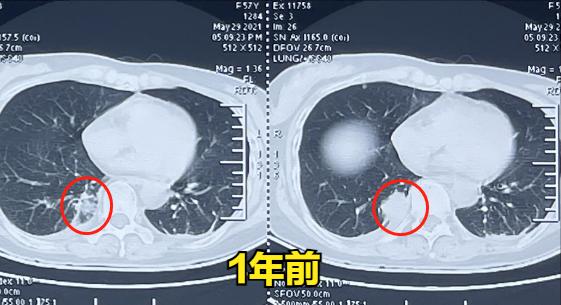 肺癌穿刺活检会使癌症发展得快吗,肺癌穿刺活检的风险