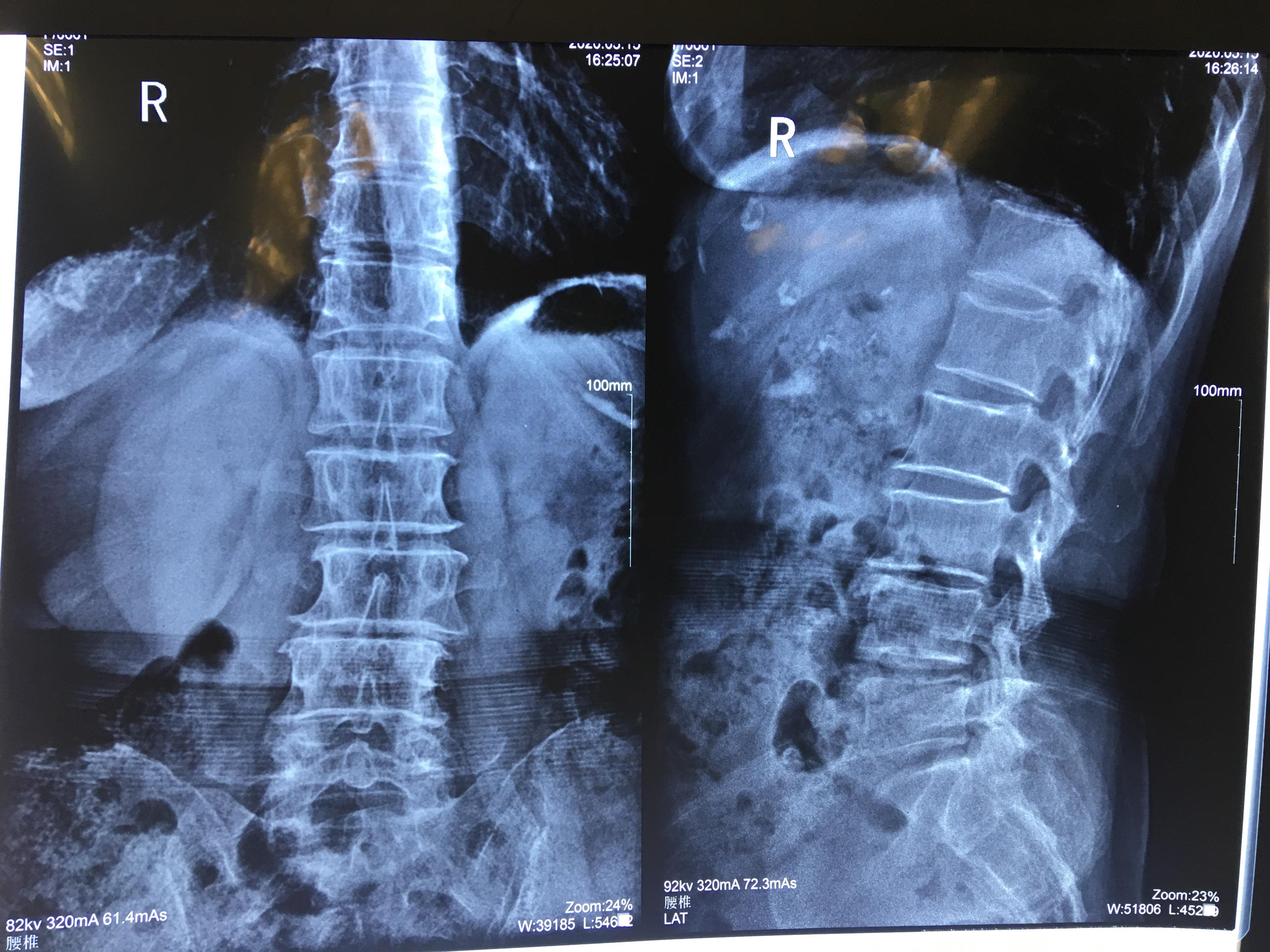 椎间盘突出伴随椎管狭窄怎么治疗,椎间盘突出导致椎管狭窄怎么治疗