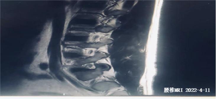 强直性脊柱炎怎么通过运动改善,目前治疗强直性脊柱炎最好的办法