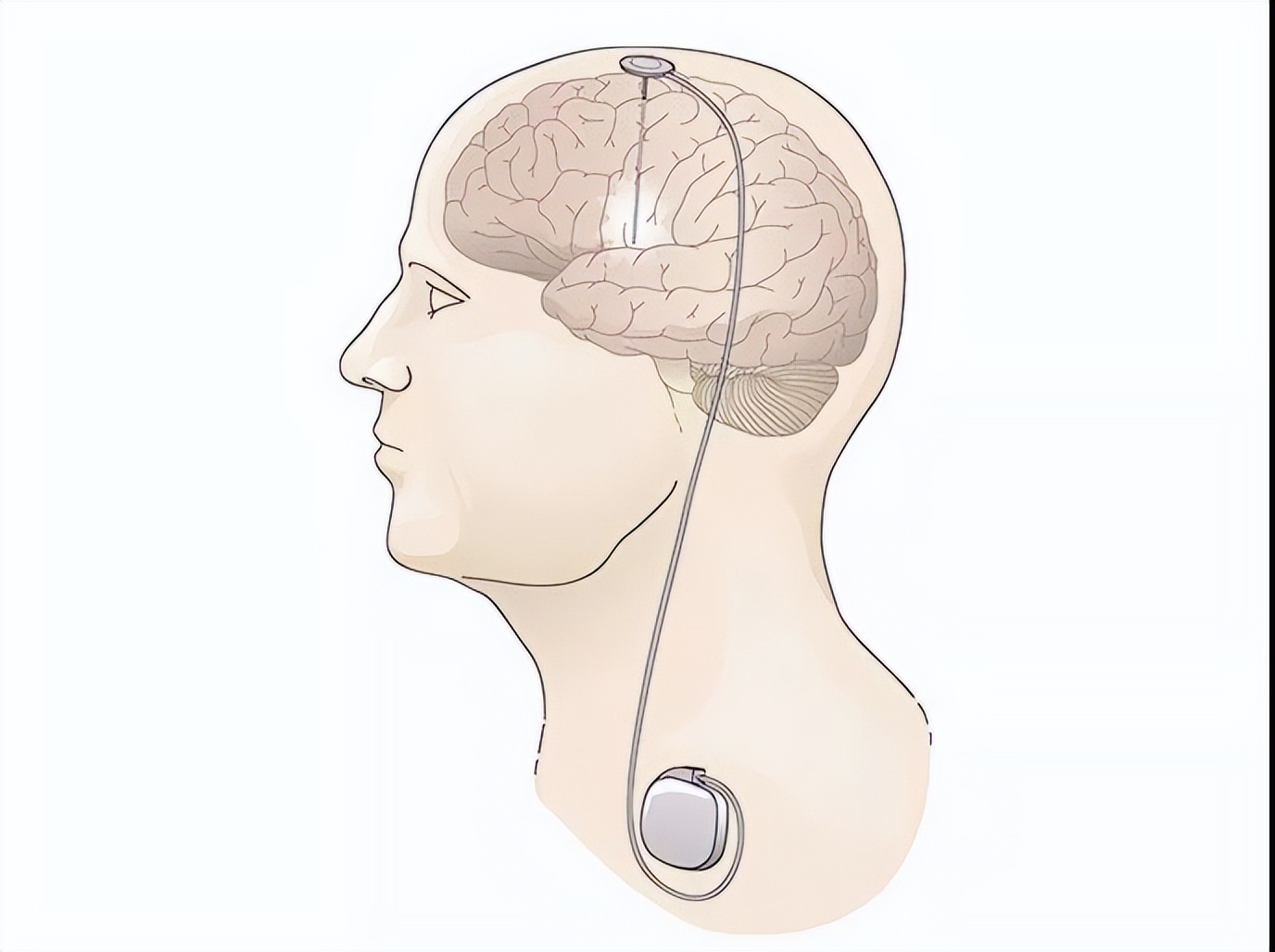 电击大脑能提高思考速度吗,电击大脑快速入眠