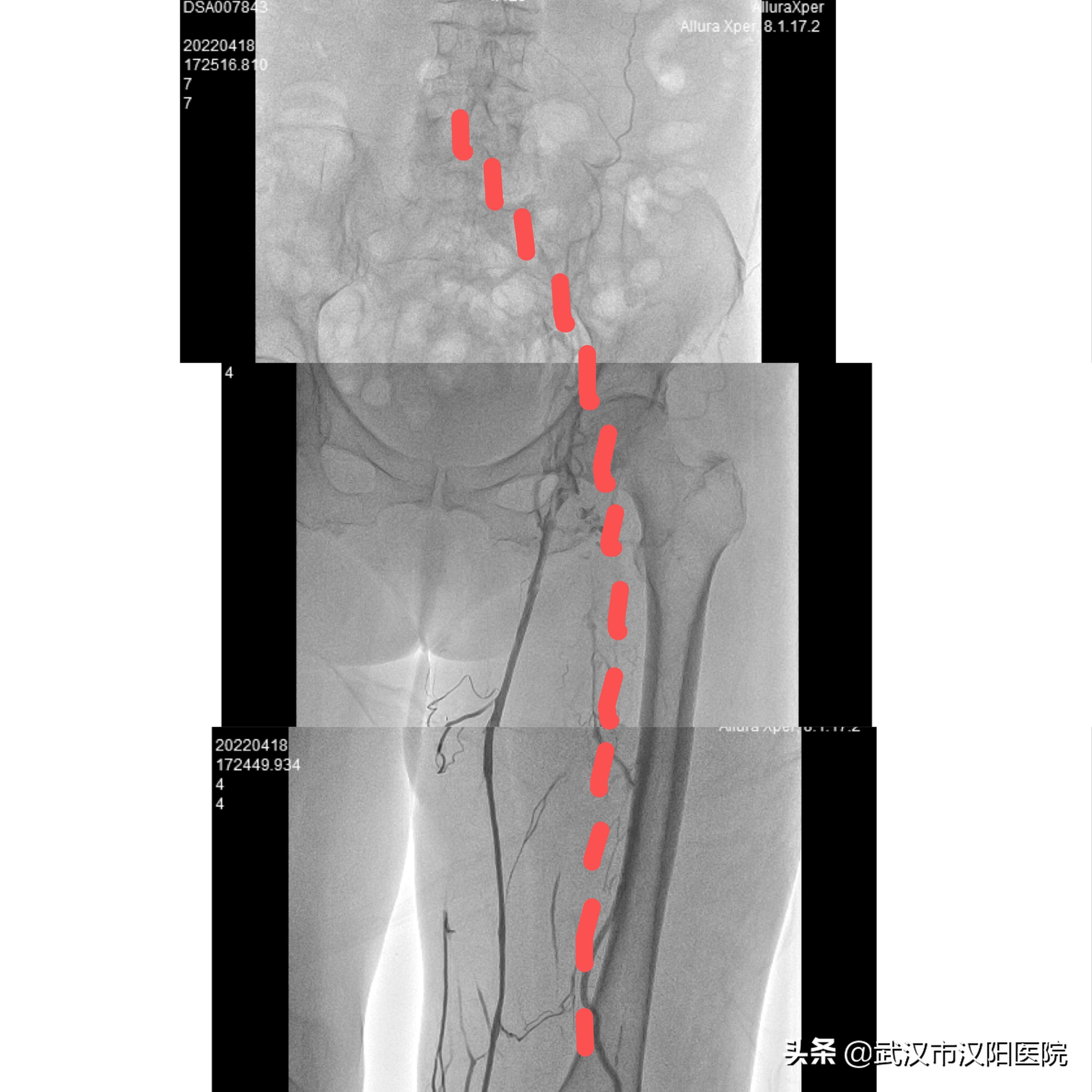 93老年人腿上有血栓怎么治,92岁老人腿血栓手术成功率有多高