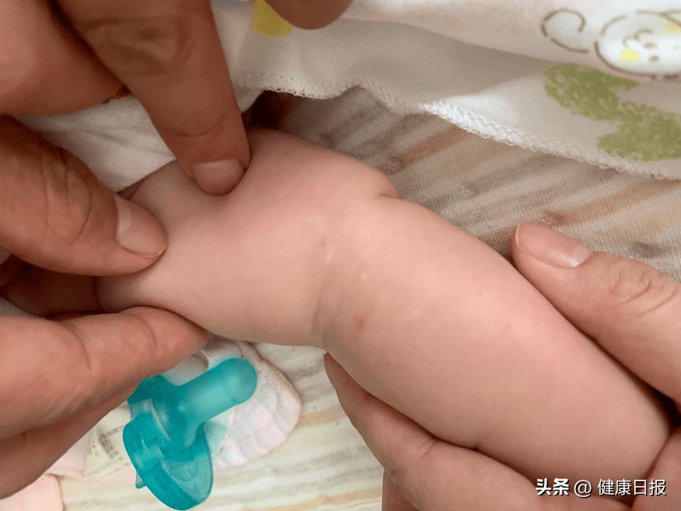 宝宝脖子有白色的圆点,宝宝皮肤上白色圆圈