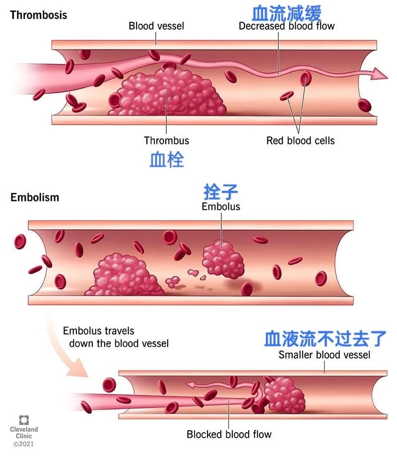 血栓最怕一味食物,心脑血栓禁忌食物