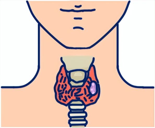 甲状腺癌为什么被称为幸福癌,为什么甲状腺癌叫幸福癌