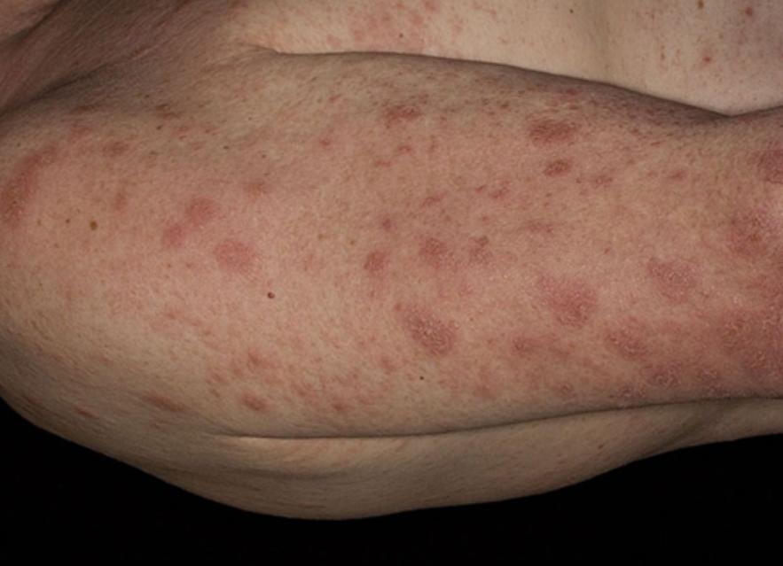 广汗法治疗银屑病效果怎么样,汗法治疗银屑病