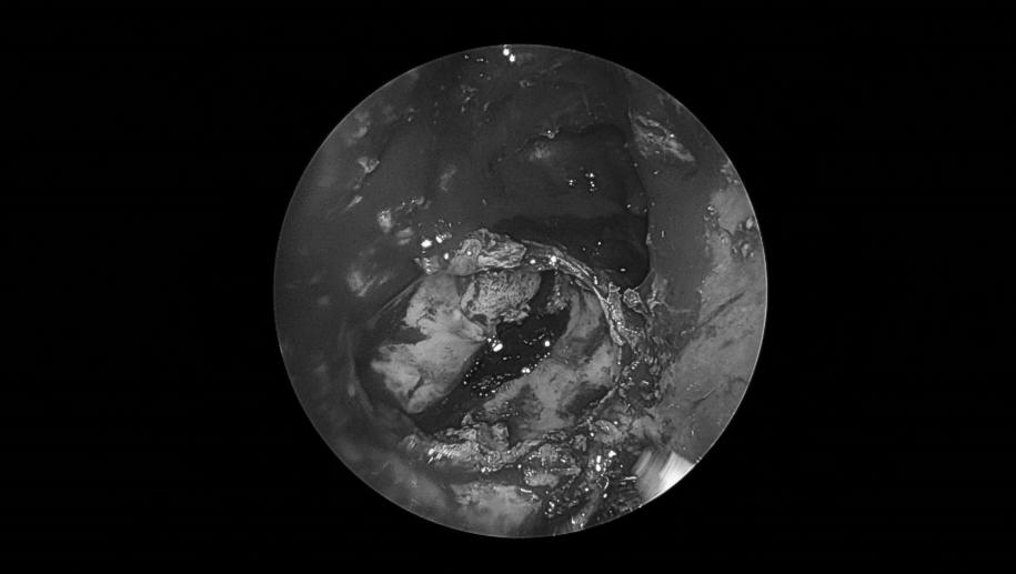 南昌二附院耳鼻喉科手术,南昌大学第二附属医院耳鼻咽喉科