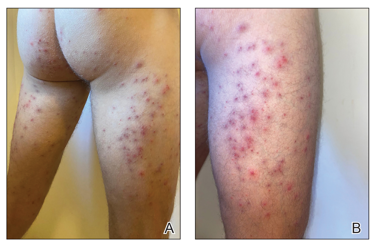 泡海水长了好多小疹子,海水泡过后皮肤变红怎么办