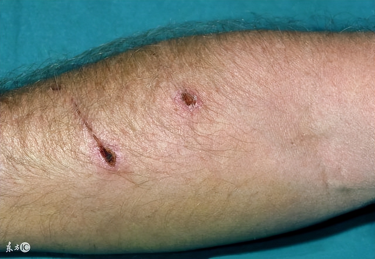 被狗咬到什么程度需要打针视频,被狗咬成什么样需要打狂犬疫苗