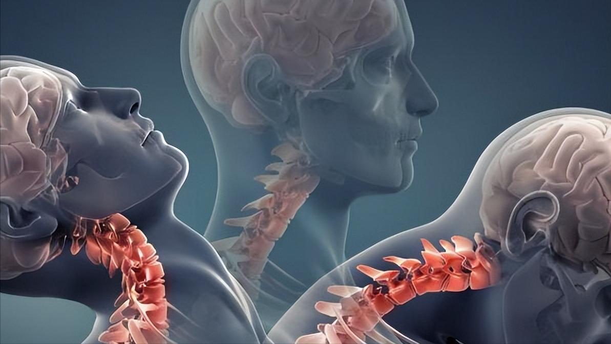 这是一封医生写给颈椎病患者的长信！如果您深受其扰，请看此文