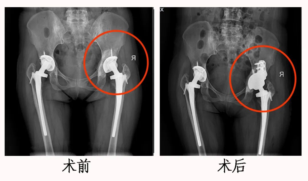 【前沿医术】3D打印，实现髋关节“私人订制”