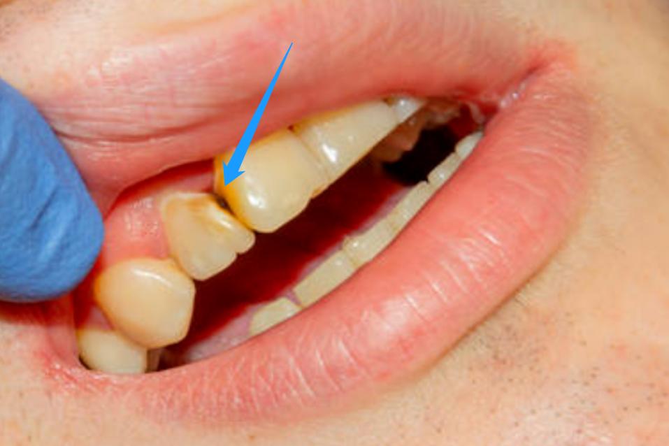 解决牙缝塞牙的办法,牙缝每天都塞牙怎么办