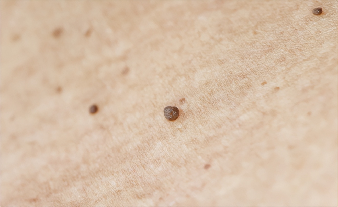 头皮上长红疙瘩脓包涂什么药膏,头皮上长红疙瘩脓包用什么药