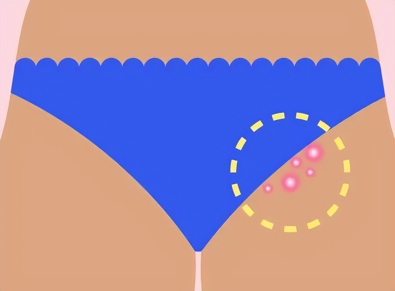 背后长了好多痘痘是性病吗,脖子下面长痘痘是性病吗