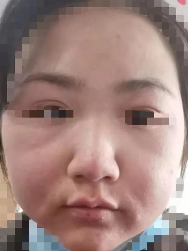 过敏期间护肤的正确方法,过敏期急救护肤用什么