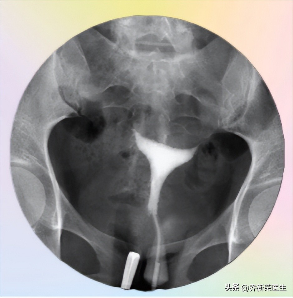 输卵管堵塞的女性，身体能感受到吗？会发生宫外孕吗？