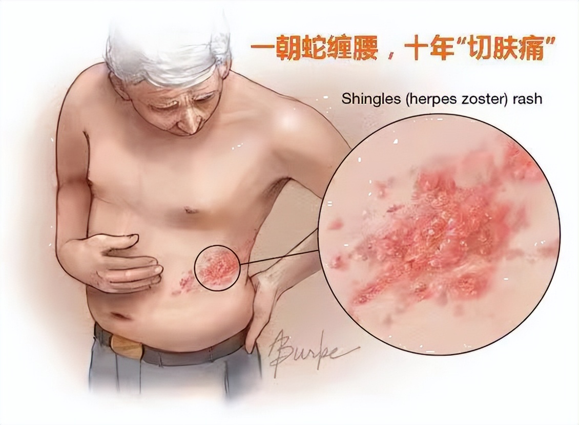 蛇缠腰带状疱疹为什么腰很痛,蛇缠腰带状疱疹要注意饮食吗