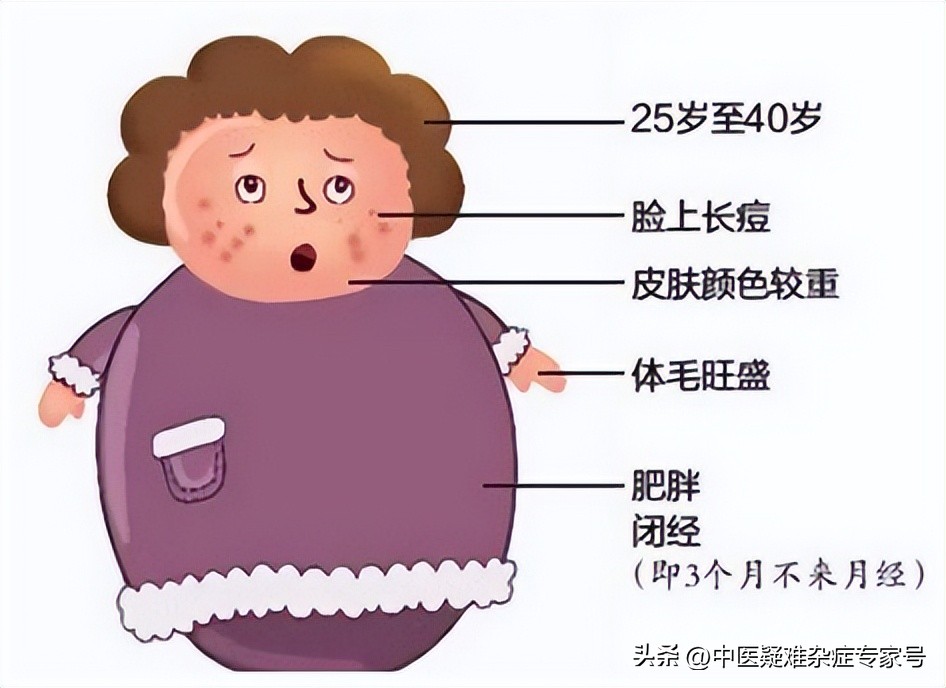 多囊卵巢综合征怎么治疗脱发,肥胖引起多囊卵巢不孕怎么办