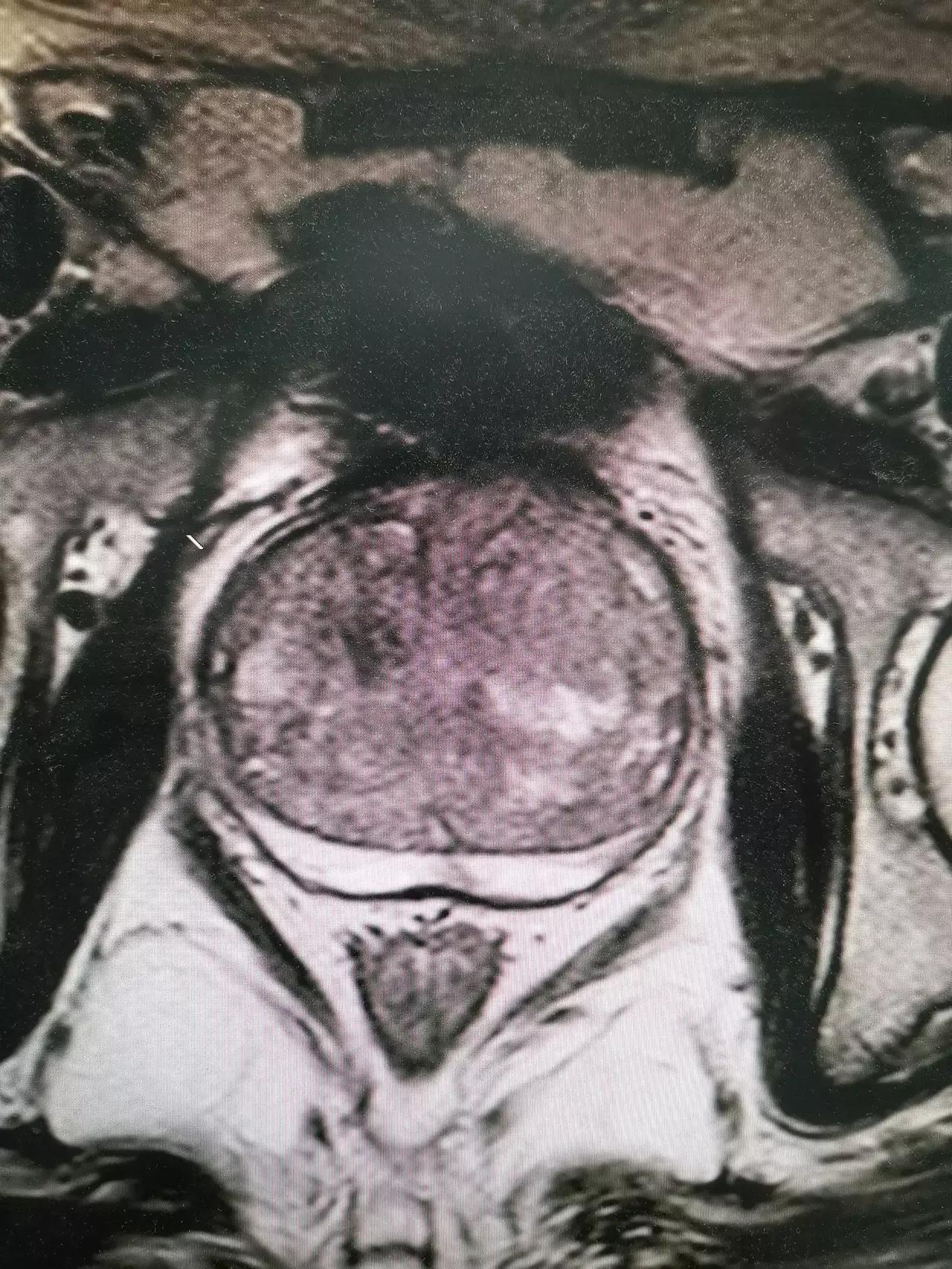 如何缓解尿频强迫症,着凉尿频怎么缓解