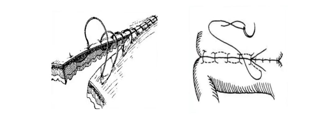 外科缝合技巧你熟练吗,外科缝合术的操作步骤