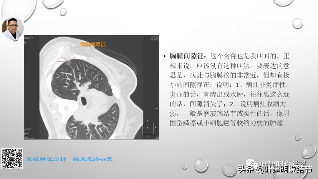 在《一脉阳光》呼吸影像诊断专题培训班上的讲课PPT（第一部分）