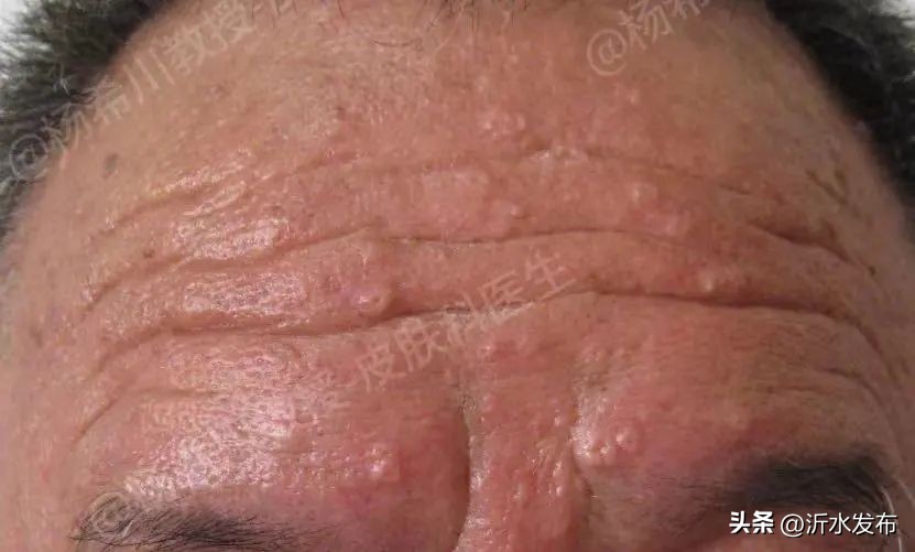 眼周长小小的疣,眼周长小丘疹是怎么回事